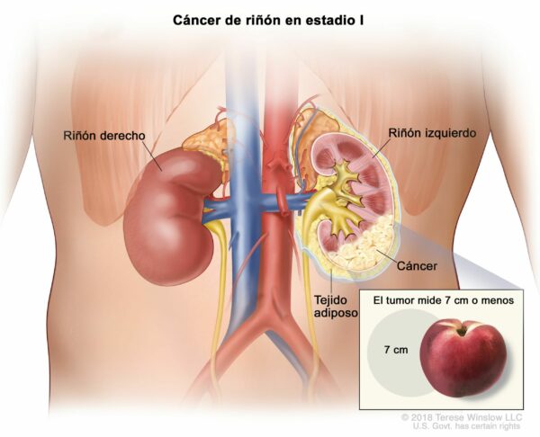 Cáncer de riñón – FundaciónCare